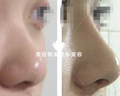 泰安玻尿酸隆鼻是一种节省又有效的隆鼻方式
